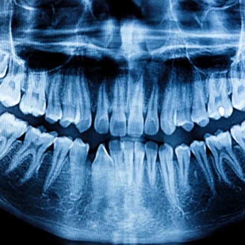 A full-mouth, panoramic X-ray.