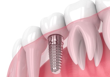 Model of a single dental implant in Garland, TX