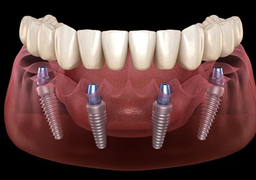 Four implants supporting a denture