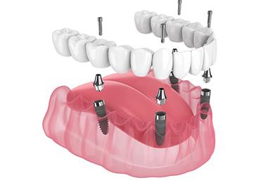 a 3D depiction of All-On-4 dental implants