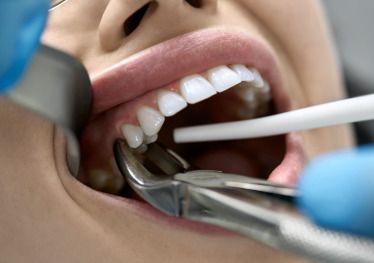 Patient in Garland undergoing a tooth extraction